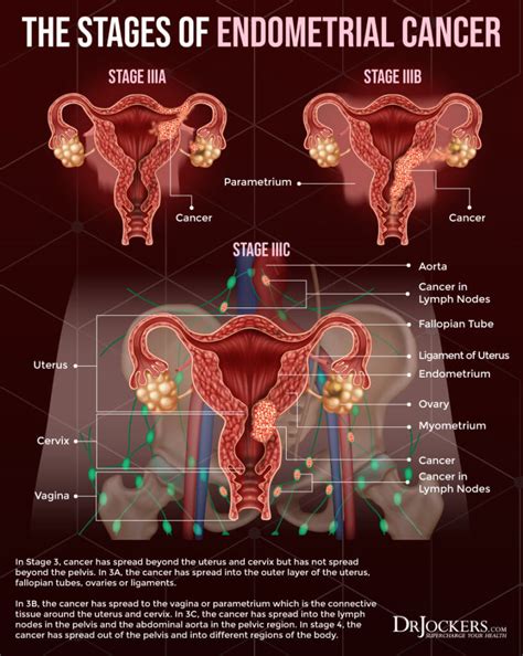 can endometriosis cause cervical cancer